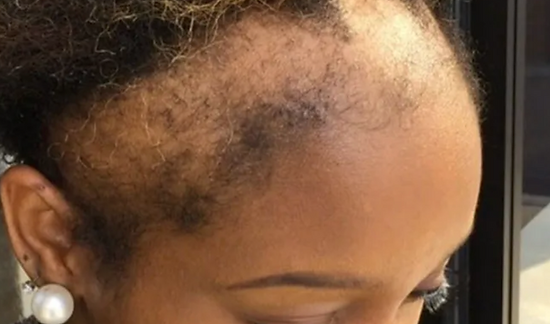 Traction Alopecia