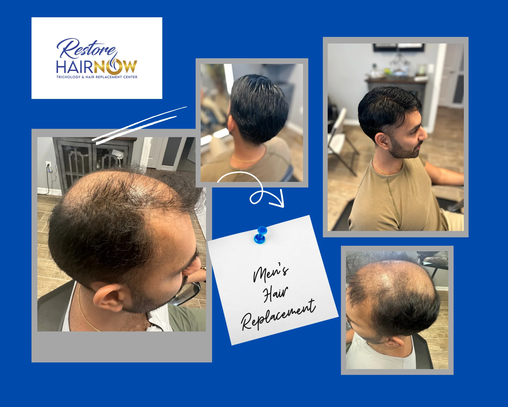 Men"s Hair Replacement